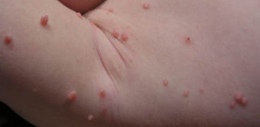Sexually Transmitted Diseases